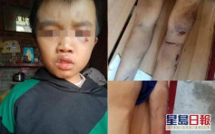 江西12歲男童滿身傷痕倒斃家中 警：父母虐待致死