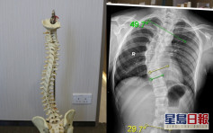 【健康talk】脊柱側彎影響長高及心肺功能 脊醫教6大檢查重點及伸展運動 