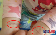 2歲女童手腕疑有勒痕 母控台南幼稚園虐兒