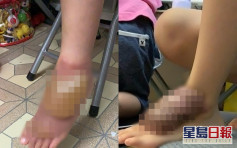 5歲兒腳部燙傷母懶理等覆診 拖一年後肉牙增生網民斥虐兒