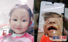黑龙江被生父继母虐打4岁女童已苏醒能进食