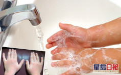 【維港會】過度清潔雙手或致濕疹 醫生提3個洗手重點