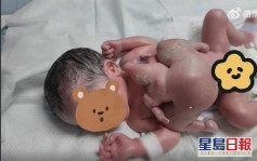 深圳男嬰出生時驚現「4手4腳」 無心無頭為寄生胎