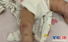 成都1岁男童遭生母虐待满身伤痕 当局介入调查