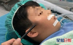 兄持玩具弓箭误射7岁弟 箭插入脸险伤及眼球与脸部神经