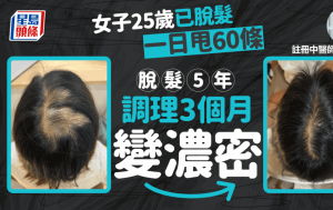 产后脱发｜脱发5年！港女25岁起日掉60条头发 中医调理3个月变浓密