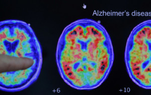 新研究：人生中創傷經歷  可致腦退化風險增