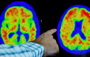 科學家發現人腦尺寸百年來不斷增長 惟近年平均智商倒退
