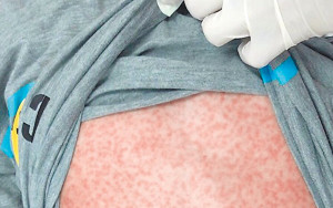 麻疹病例全球飆升｜台灣爆首宗本土群聚感染個案 醫生點名3類人快打疫苗
