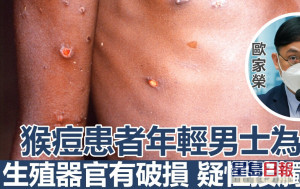 猴痘蔓延｜歐家榮指患者年輕男士為主 料對香港風險較低