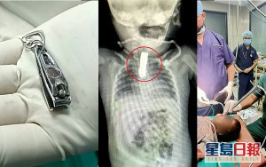 8個月大男嬰誤吞5厘米指甲鉗 歷1小時手術逃出死劫