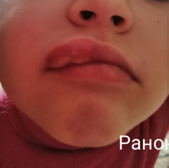 乌克兰6岁女童睇牙医后嘴巴异常肿胀。（网图）