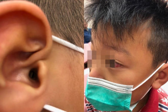 轩仔的右耳被人用铅笔插入，致擦胶留在耳道逾一周发炎。资料图片