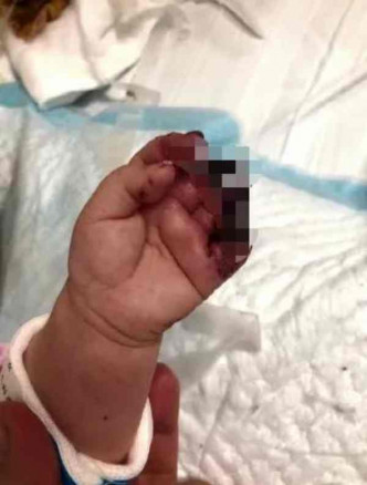 女嬰手指更被吃掉半截。網圖