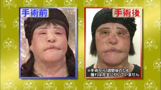 日本名醫為她動了17次手術後的情況。網圖