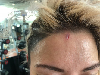 JuJu拍《五行剌客》之《復仇之拳》意外被攝影機撞傷額頭，傷口有1寸長。