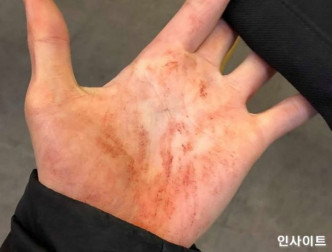 治彬的脸和手都是伤痕。