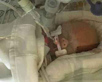 新生女嬰在深切治療部已可自行呼吸。AP