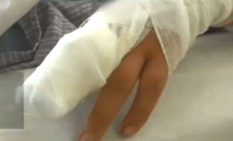 黑龍江女童因祖母亂用偏方導致手指截肢。網上圖片