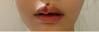 Aka去年被流浪狗咬傷嘴唇。