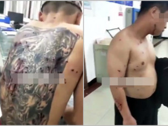 有網民拍到兩名赤膊上身的年輕男子，背部布滿了疑是互射煙花所造成的「釘孔」傷痕，到醫院求醫。 網圖