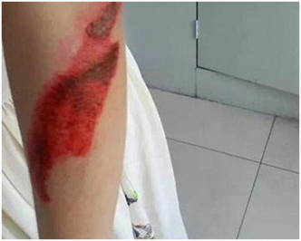 女博士生手臂受伤。网上图片