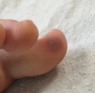 一些新冠肺炎患者的腳上出現了「類似水痘或麻疹」的病變。(網圖)