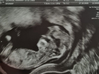 英國一名孕婦近日拿到胎兒超音波照後，發現寶寶的側面竟然神似美國總統特朗普。Hana facebook