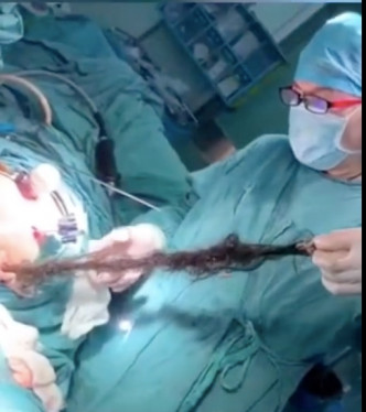 醫生在畸胎瘤拉出長達兩米多的毛髮。網圖