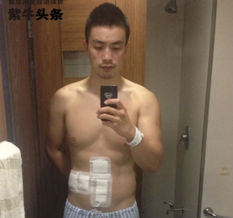 王偉腹部的疤痕就是當年手術留下的。網圖