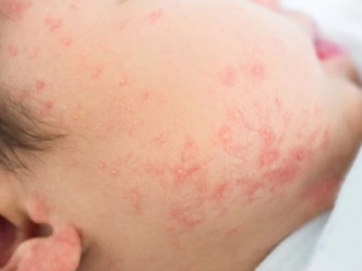 小兒濕疹的病徵包括皮膚乾燥及痕癢、脫皮、出現紅疹及丘疹等。