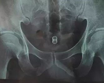 Ｘ光片顯示有一長條類管子從肛門進入直腸。網圖
