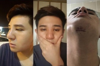 Steven Yong在社交平台上分享了自己整容的「進化過程」，捱刀的疤痕照片也少不了。（Facebook圖片）