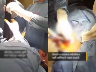 醫生取出鐵管（左），及處理傷口（右）。網絡圖片