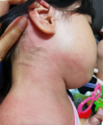 3歲女童頸部肩膀出紅疹。市民圖片