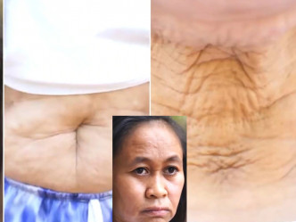 菲律宾少女患早衰症，身体多处出现皱纹。 （网上图片）
