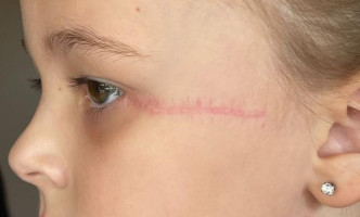 6岁女童遭吊扇割脸缝100针留疤痕，险失明。网图