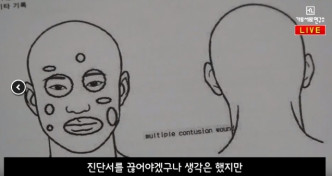 受害人B某於韓國節目《橫豎研究所》騷出當時的醫院診斷書，證實被金健模打致眼眶和鼻骨骨折。