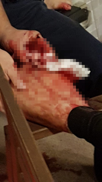 一名男辅警遭野猪咬伤警员右小腿及腰部。读者提供