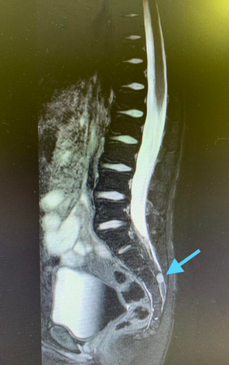 医生发现Sheldon的脊椎最尾段还有一个肿瘤。FB图片