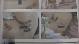 女子身上留下17条大小不一的刀疤。 网图