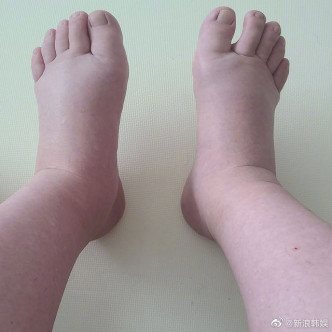 黃申英雙腳非常浮腫。