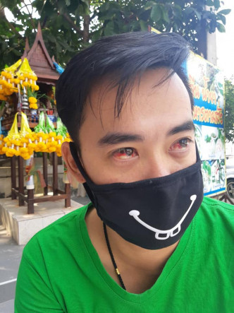 泰國男子咳嗽、眼球冒血、吐血。網上圖片