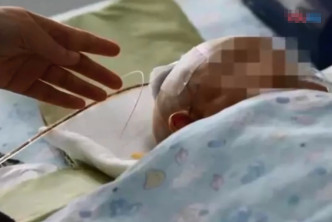 東莞一名女嬰一個「從天而降」的蘋果砸傷頭部。　網上圖片