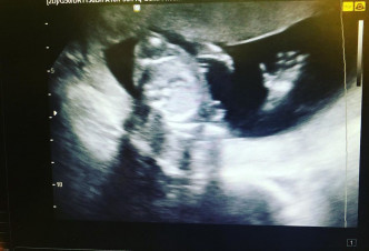 上月中，杨怡于社交网贴出超声波照宣布怀孕，预产期5月。