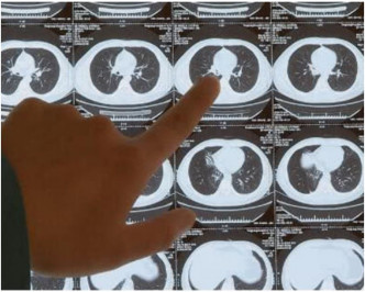 CT影像發現右肺竟有異物卡著。