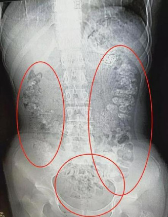 經CT檢查後，少女的胃部及腸道內佈滿百多粒未消化的珍珠。網圖