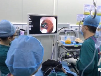 醫生用內鏡微創手術花了近4個小時才將磁珠取出。網圖