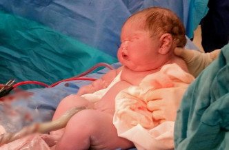 肥嘟嘟的阿尔法由两名护士将他拉出母体。互联网图片