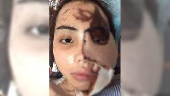 越南男警怀疑妻子出轨泼强酸毁容。网上图片